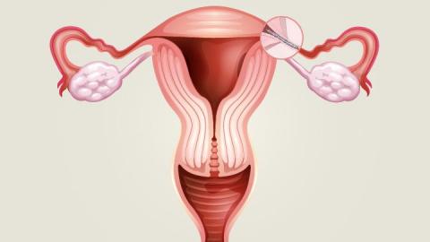 Essure Adverse Event Reports Doubled Last Year