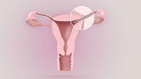 Essure Lawsuits Explained in the Context of Federal Preemption