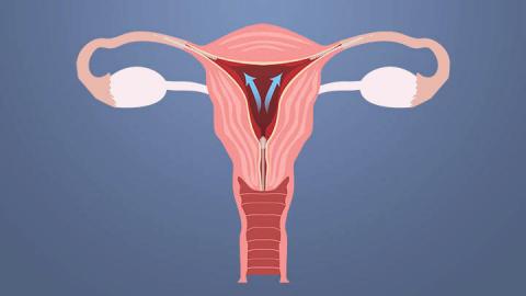 Judge Allows Philadelphia Essure Suit to Proceed