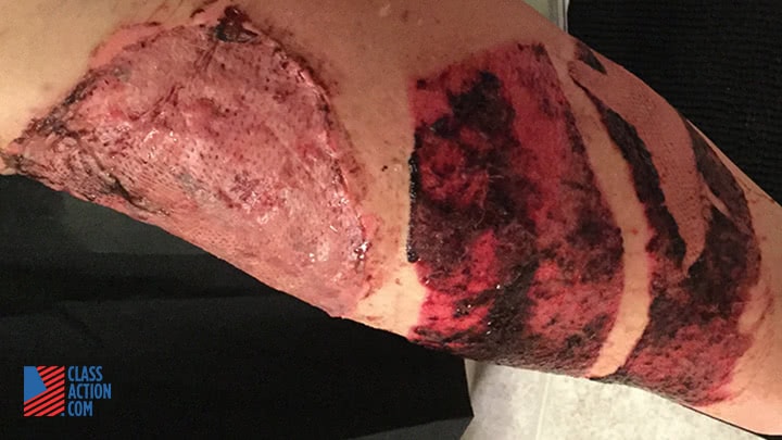 Mr Ramirez has undergone multiple skin grafts