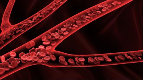 What You Need to Know About IVC Filter Complications